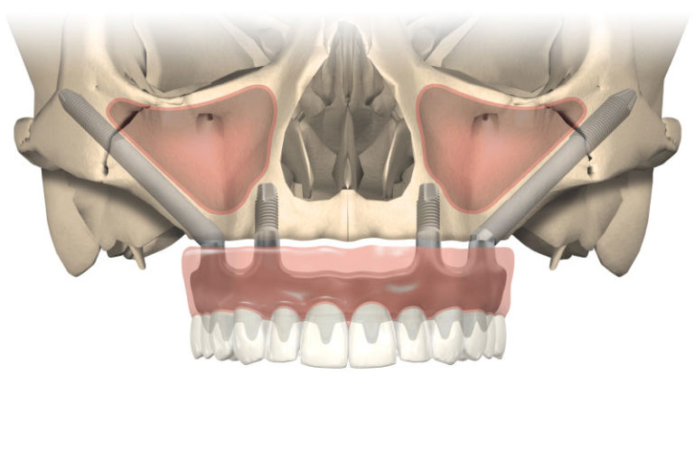 Zygoma-Implantate